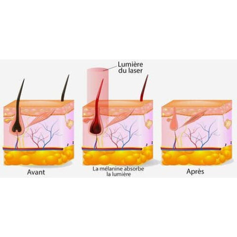 épilateur à Lumière Pulsée Intense Ipl 999 Flashs Visage et