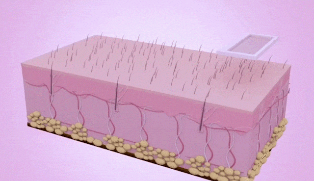Épilateur à Lumière Pulsée Intense Ipl 999 Flashs